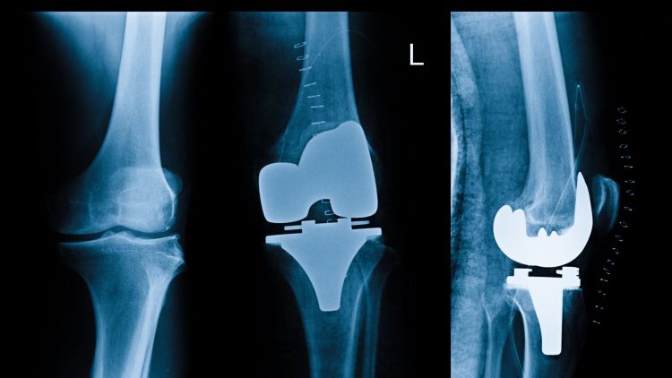 Röntegnbilder mit Knieprothesen