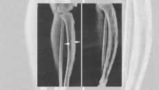 Röntgenbilder eine Pageterkrankung am Unterschenkel