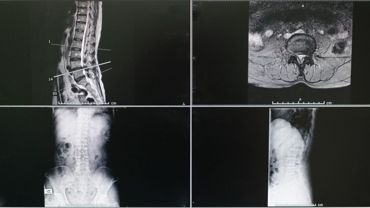 Röntgen- und Kernspinbilder einer Wirbelsäule
